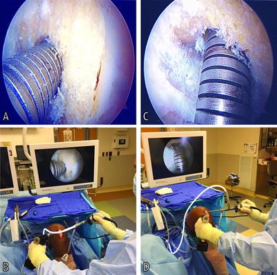 Arthroscopic Viewing Position Affects Anterior Cruciate Ligament Reconstruction Femoral Tunnel Length Measurements